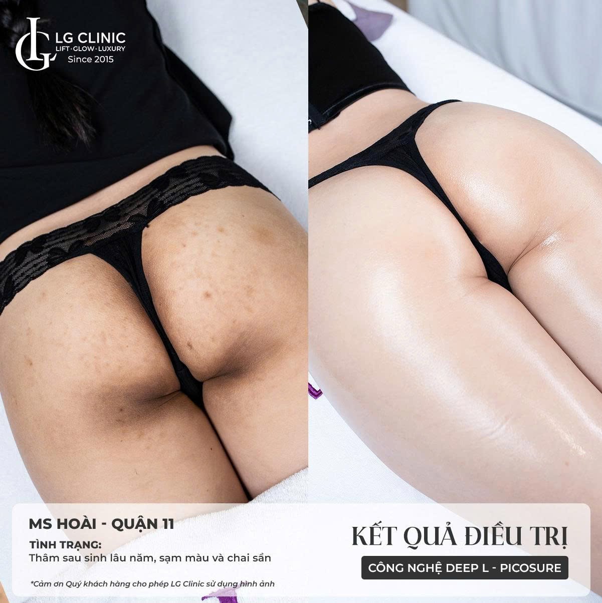 địa chỉ trị thâm body uy tín